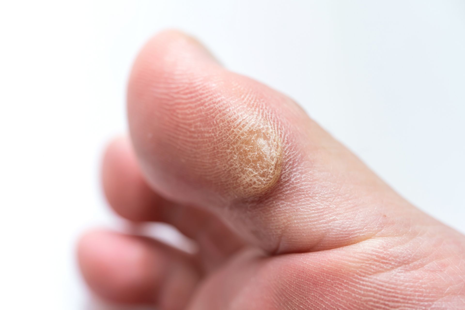 タコを丁寧にケア | 出張のフットケアならDr.ネイル爪革命青梅